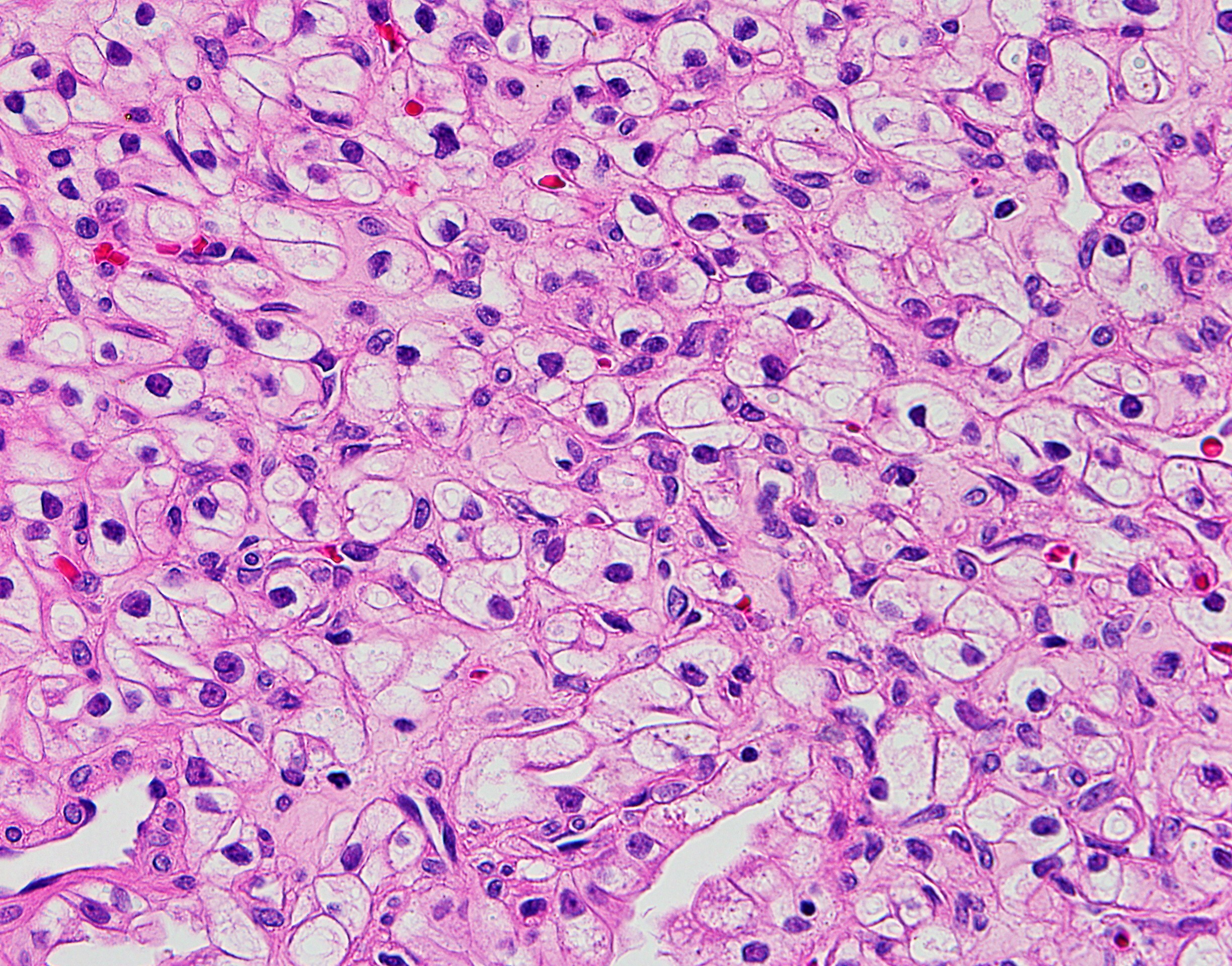 presentation of renal clear cell carcinoma